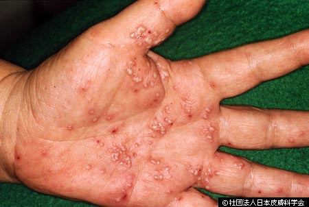 掌蹠膿疱症 しょうせきのうほうしょう の原因と症状 治療 吹田市 江坂のたまき皮フ科
